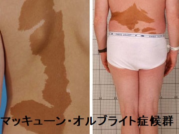 マッキューン・オルブライト症候群 皮膚カフェオレ斑 マッキューン・オルブライト症候群 皮膚カフェオレ斑