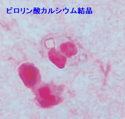 甲状腺と偽痛風 ピロリン酸カルシウム結晶 甲状腺と偽痛風 ピロリン酸カルシウム結晶
