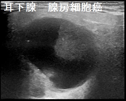 耳下腺 腺房細胞癌 超音波(エコー)画像 耳下腺 腺房細胞癌 超音波(エコー)画像
