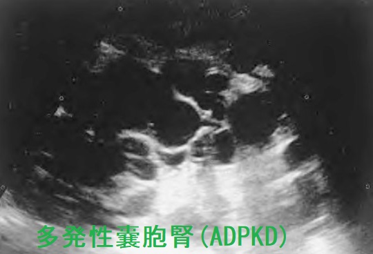 多発性嚢胞腎 超音波エコー画像 多発性嚢胞腎 超音波エコー画像