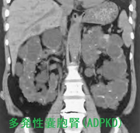 多発性嚢胞腎 CT画像 多発性嚢胞腎 CT画像