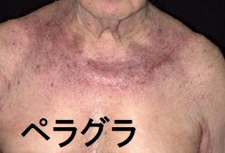 ペラグラ 皮膚症状 ペラグラ 皮膚症状