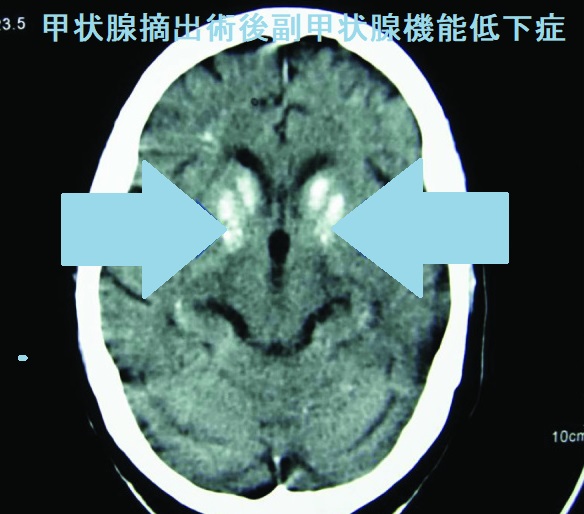 甲状腺摘出術後副甲状腺機能低下症 甲状腺摘出術後副甲状腺機能低下症