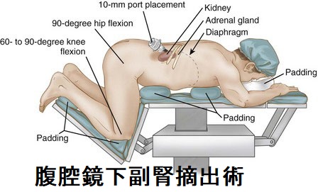 腹腔鏡下副腎摘出術 腹腔鏡下副腎摘出術