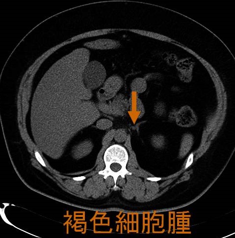 褐色細胞腫 CT画像 褐色細胞腫 CT画像