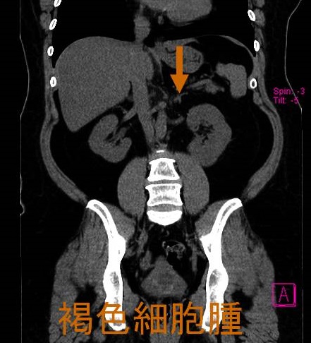 褐色細胞腫 CT画像 褐色細胞腫 CT画像