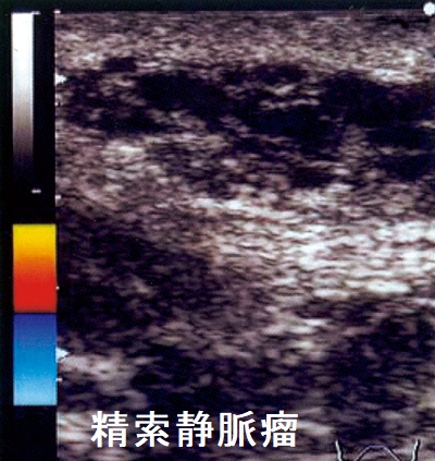 精索静脈瘤 超音波(エコー)画像 精索静脈瘤 超音波(エコー)画像