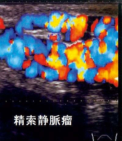 精索静脈瘤 超音波(エコー)画像 ドプラー 精索静脈瘤 超音波(エコー)画像 ドプラー