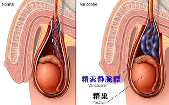 精索静脈瘤 精索静脈瘤