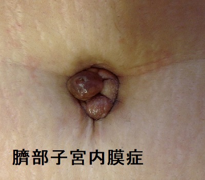 臍部子宮内膜症 臍部子宮内膜症