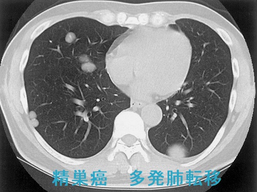 精巣癌 多発肺転移 精巣癌 多発肺転移