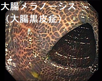 大腸メラノーシス(大腸黒皮症) 大腸メラノーシス(大腸黒皮症)