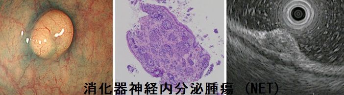 消化器内視鏡第28巻11号 よくわかる消化器神経内分泌腫瘍(NET/NEC) 大腸カメラでわかる病気(更新)：消化管神経内分泌腫瘍（NET