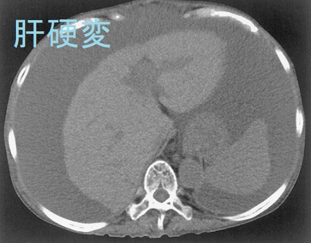 肝硬変 肝硬変