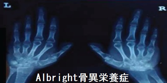 Albright骨異栄養症 Albright骨異栄養症