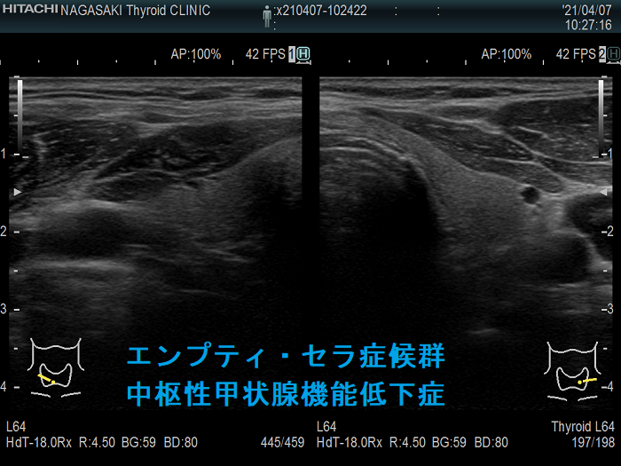 エンプティ・セラ症候群 中枢性甲状腺機能低下症 エンプティ・セラ症候群 中枢性甲状腺機能低下症