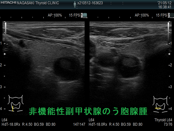 非機能性副甲状腺のう胞腺腫 超音波エコー画像 非機能性副甲状腺のう胞腺腫 超音波エコー画像