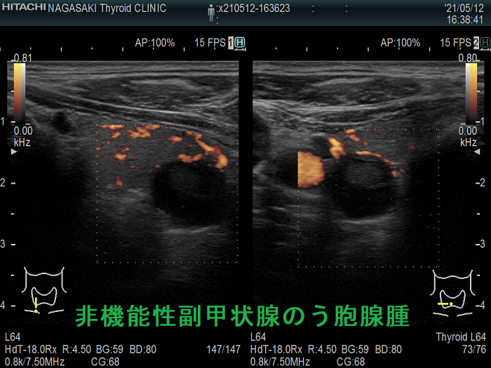 非機能性副甲状腺のう胞腺腫 超音波エコー画像 ドプラーモード 非機能性副甲状腺のう胞腺腫 超音波エコー画像 ドプラーモード