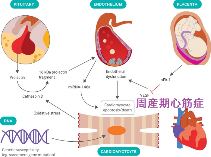 周産期心筋症 周産期心筋症