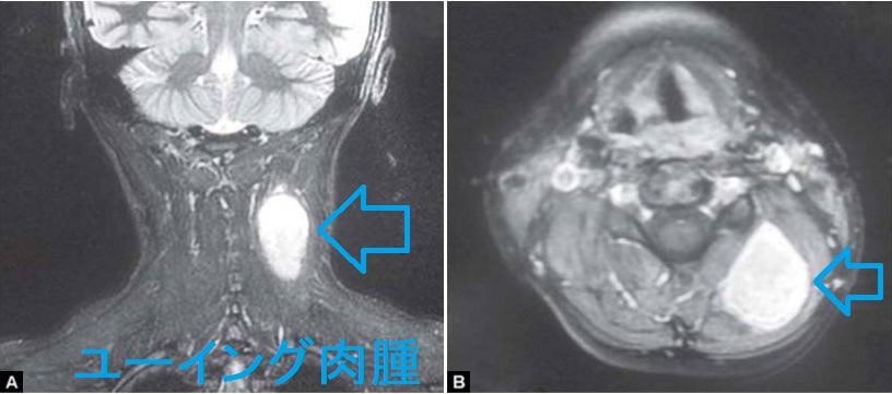 ユーイング肉腫 MRI画像 ユーイング肉腫 MRI画像