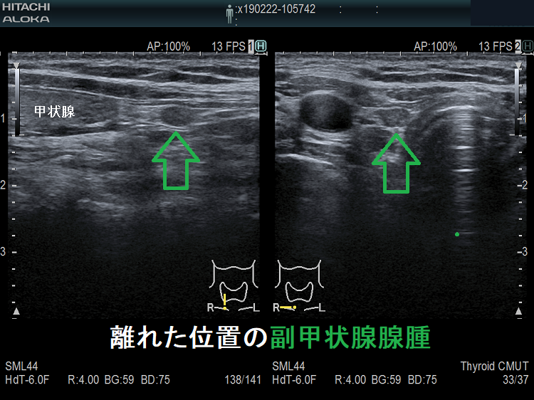 離れた位置の副甲状腺腺腫 超音波(エコー)画像 離れた位置の副甲状腺腺腫 超音波(エコー)画像