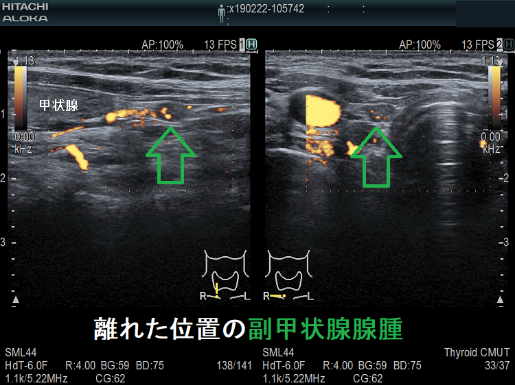 離れた位置の副甲状腺腺腫超音波(エコー)画像 ドプラーモード 離れた位置の副甲状腺腺腫超音波(エコー)画像 ドプラーモード