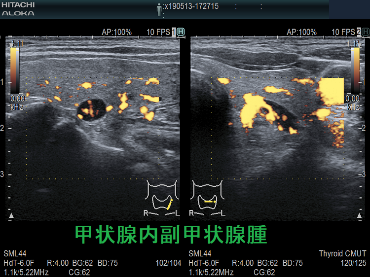 甲状腺内副甲状腺腫 ドプラーモード 甲状腺内副甲状腺腫 ドプラーモード