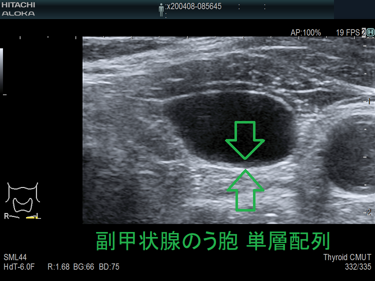 副甲状腺のう胞 単層配列 副甲状腺のう胞 単層配列