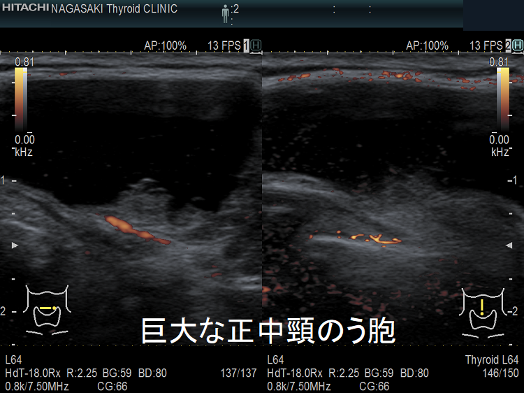 巨大な正中頸のう胞(甲状舌管嚢胞) 超音波(エコー)画像 拡大 巨大な正中頸のう胞(甲状舌管嚢胞) 超音波(エコー)画像 拡大