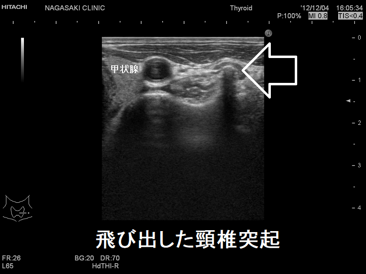 飛び出した頸椎突起 超音波(エコー)画像 飛び出した頸椎突起 超音波(エコー)画像
