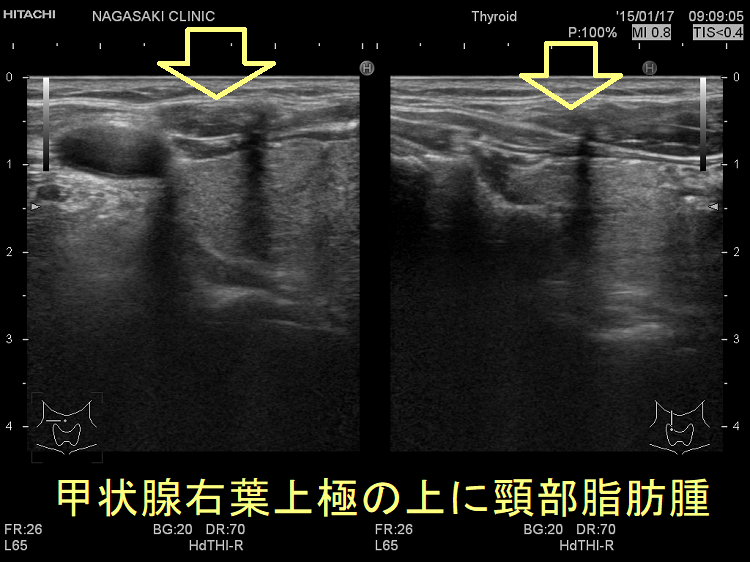 甲状腺右葉上極の上に頸部脂肪腫 甲状腺右葉上極の上に頸部脂肪腫
