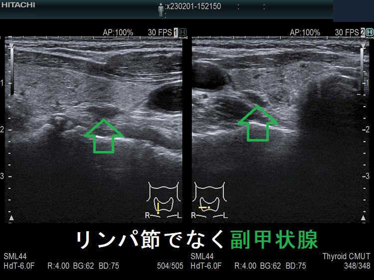 リンパ節でなく副甲状腺 リンパ節でなく副甲状腺