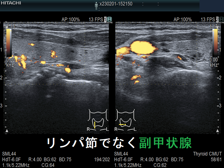 リンパ節でなく副甲状腺 ドプラーモード リンパ節でなく副甲状腺 ドプラーモード