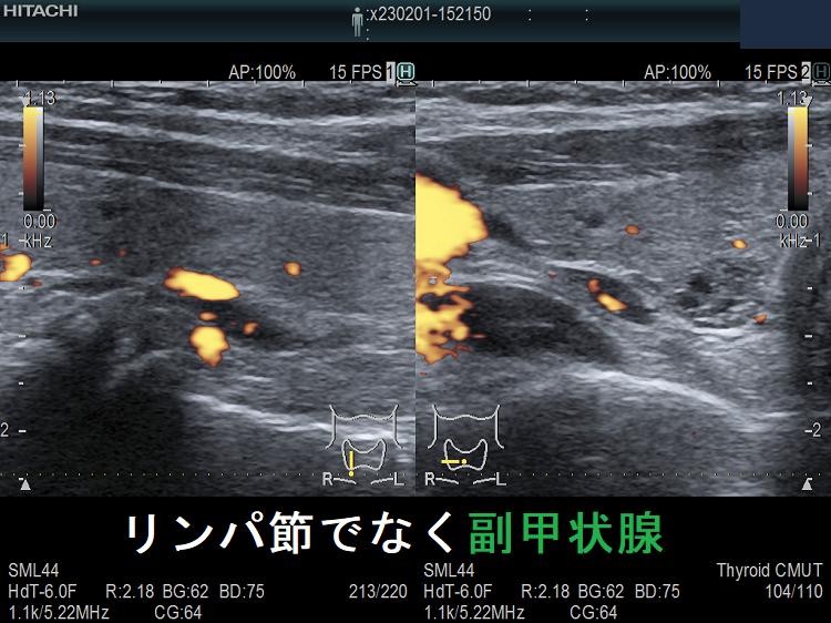 リンパ節でなく副甲状腺 ドプラーモード (拡大) リンパ節でなく副甲状腺 ドプラーモード (拡大)