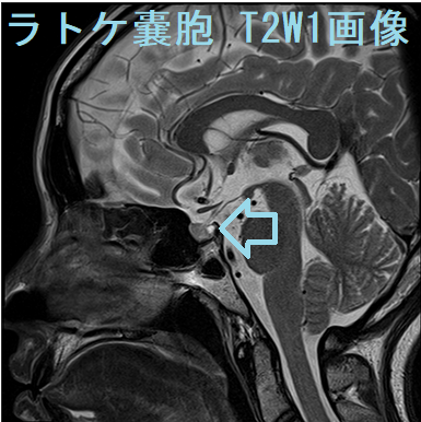 ラトケ嚢胞MRI 画像 T2W1 ラトケ嚢胞MRI 画像 T2W1