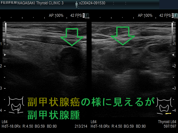 副甲状腺癌の様に見えるが副甲状腺腫 副甲状腺癌の様に見えるが副甲状腺腫