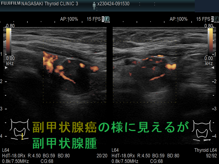 副甲状腺癌の様に見えるが副甲状腺腫 ドプラーモード 副甲状腺癌の様に見えるが副甲状腺腫 ドプラーモード