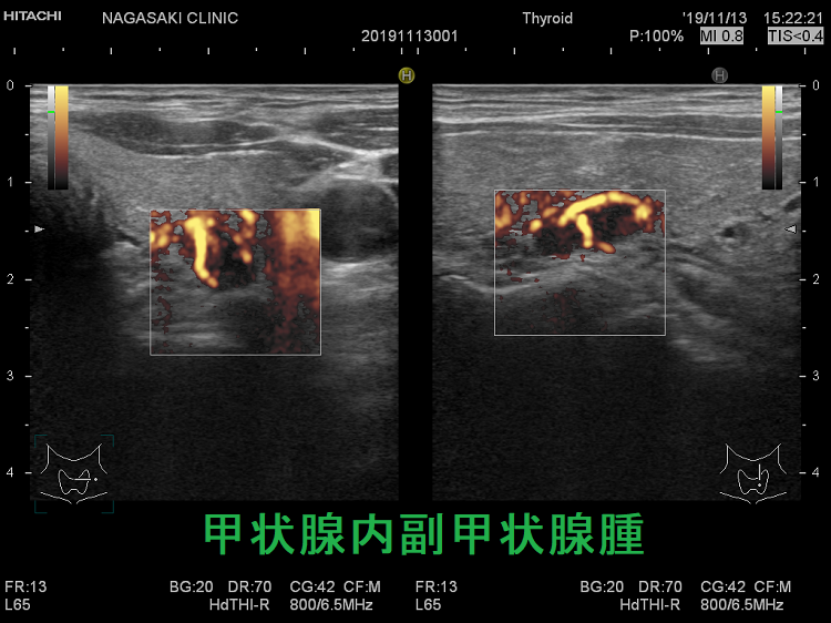 甲状腺内副甲状腺腫 ドプラー 甲状腺内副甲状腺腫 ドプラー