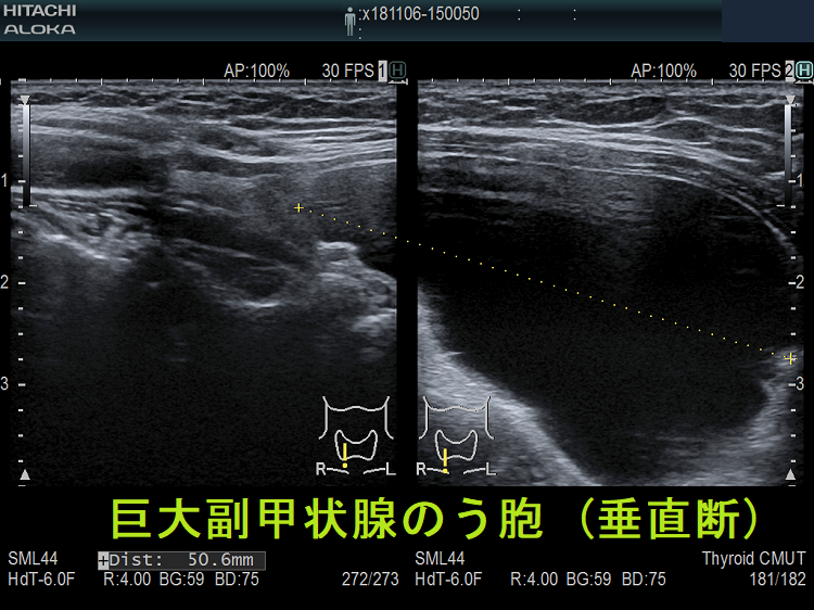巨大副甲状腺のう胞 (超音波エコー画像 垂直断) 巨大副甲状腺のう胞 (超音波エコー画像 垂直断)