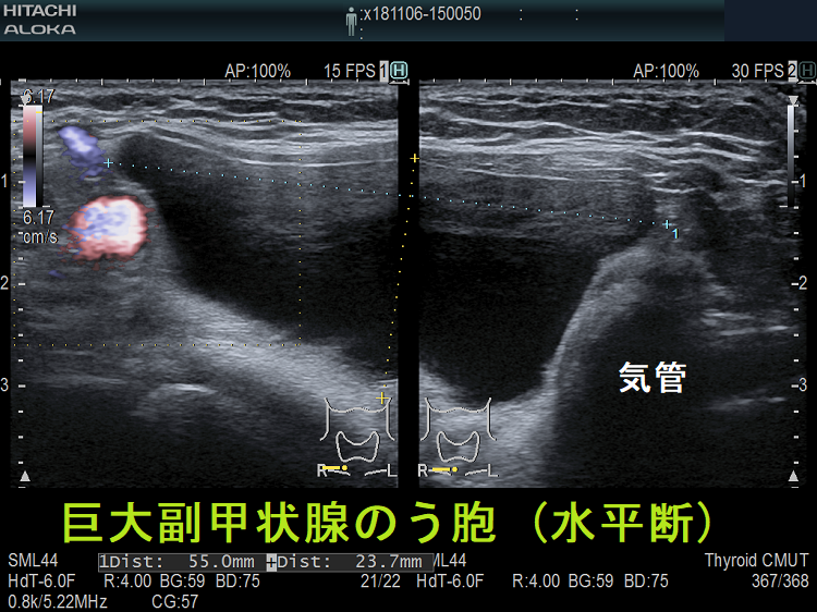 巨大副甲状腺のう胞 (超音波エコー画像 水平断) 巨大副甲状腺のう胞 (超音波エコー画像 水平断)