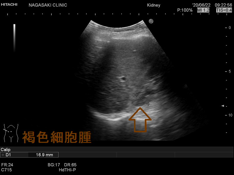 褐色細胞腫 超音波(エコー)画像 褐色細胞腫 超音波(エコー)画像