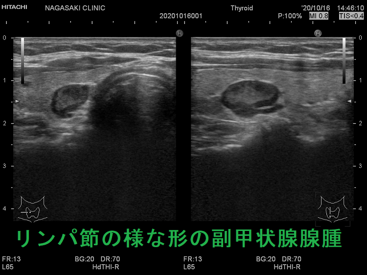あたかもリンパ節の様な形の副甲状腺腺腫 あたかもリンパ節の様な形の副甲状腺腺腫