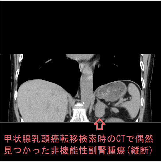 甲状腺乳頭癌転移検索時のCTで偶然見つかった非機能性副腎腫瘍(縦断) 甲状腺乳頭癌転移検索時のCTで偶然見つかった非機能性副腎腫瘍(縦断)