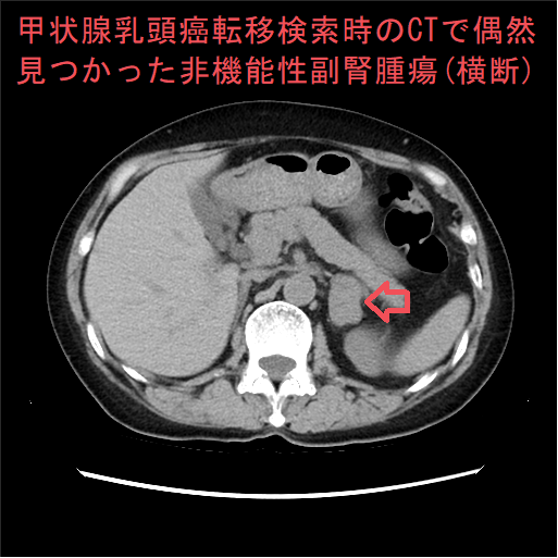 甲状腺乳頭癌転移検索時のCTで偶然見つかった非機能性副腎腫瘍(横断) 甲状腺乳頭癌転移検索時のCTで偶然見つかった非機能性副腎腫瘍(横断)