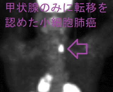 甲状腺のみに転移を認めた小細胞肺癌 FDG‐PET CT 甲状腺のみに転移を認めた小細胞肺癌 FDG‐PET CT