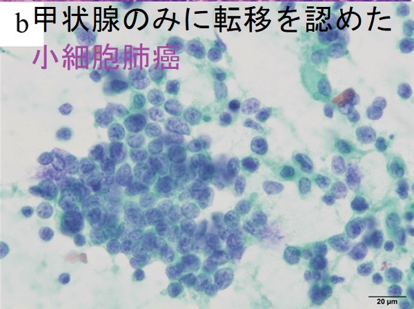 甲状腺のみに転移を認めた小細胞肺癌 細胞診 甲状腺のみに転移を認めた小細胞肺癌 細胞診