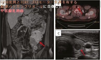 SDHB変異とTERT プロモーター変異を有する腹部パラガングリオ-マに合併した甲状腺乳頭癌 SDHB変異とTERT プロモーター変異を有する腹部パラガングリオ-マに合併した甲状腺乳頭癌