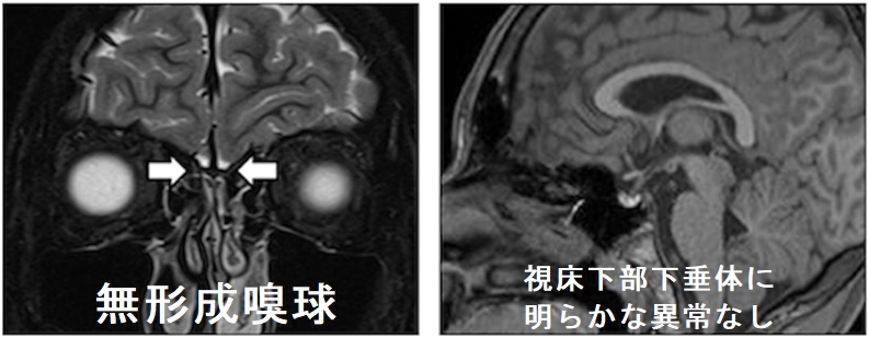 無形成嗅球、視床下部下垂体に明らかな異常なし 無形成嗅球、視床下部下垂体に明らかな異常なし