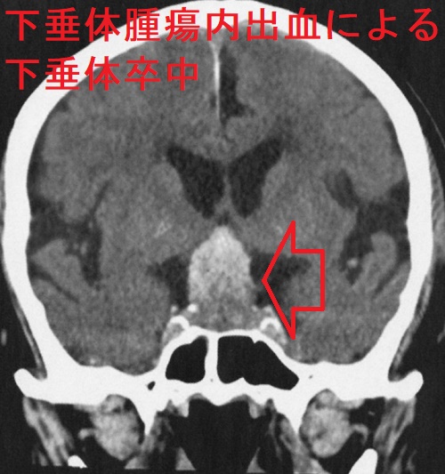 下垂体腫瘍内出血による下垂体卒中 冠状断像 下垂体腫瘍内出血による下垂体卒中 冠状断像