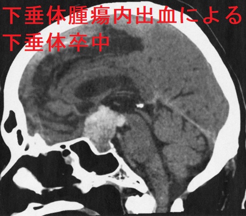 下垂体腫瘍内出血による下垂体卒中 矢状断像 下垂体腫瘍内出血による下垂体卒中 矢状断像